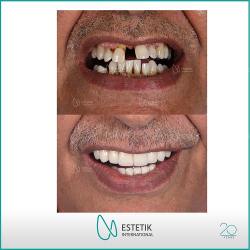 زراعة الشعر صور قبل وبعد